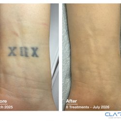 Before and After using the Picoway laser. 8 treatments total on black ink.
