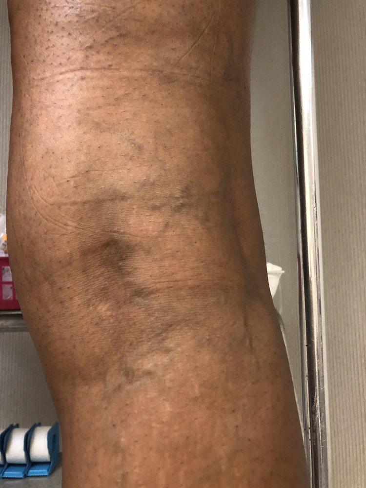 SCHULMAN VEIN AND LASER CENTER 29 Photos & 20 Reviews 1165 Park Ave