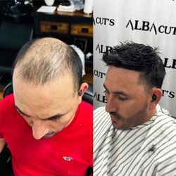 Albacuts - Sistema capilar. Hair system