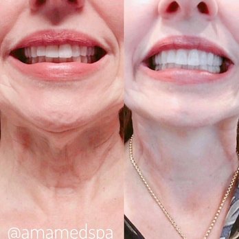 Time 4 U Med Spa - Botox to the Platysmal Bands - Medical Spas Near Me - Naples, Florida Time 4 U Med Spa - Botox to the Platysmal Bands - Medical Spas Near Me - Naples, Florida