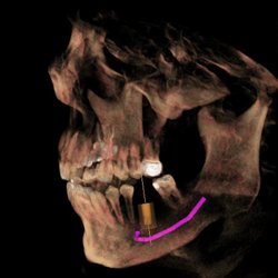 The Dental Center Of Hercules - 3D Imaging for precise dental implant planning.