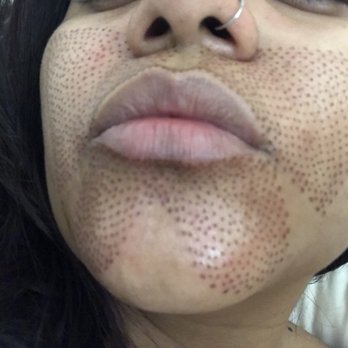 Skin Deep Aesthetics - Fibroblast facial - Estheticians Near Me - Granada Hills, California Skin Deep Aesthetics - Fibroblast facial - Estheticians Near Me - Granada Hills, California