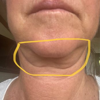 Blue Illusion Beauty - Post neck lift - Cosmetic Surgeons Near Me - San Diego, California Blue Illusion Beauty - Post neck lift - Cosmetic Surgeons Near Me - San Diego, California