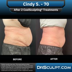 Dr. Sculpt CoolSculpting & EmSculpt Center - After 2 CoolSculpting treatments on abdomen/flanks