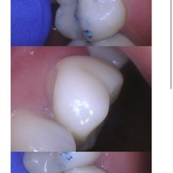 Farwest Dental Group - Look how bad the crowds they used were they don't fit at all and they shaved them down so much you can see holes and cracks