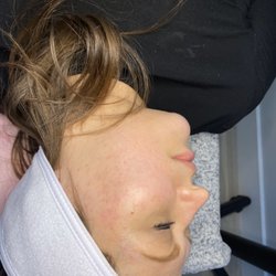 Ozone dermaplaning facial. Acne treatment.