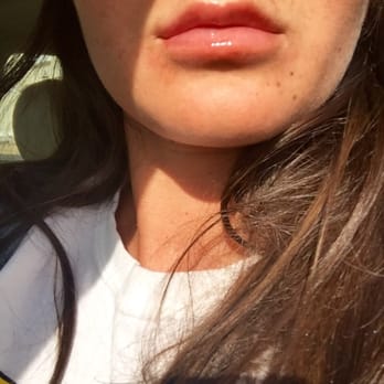 Embody Medspa - I had the nurse do my lips with juvederm and couldn't be happier with my results. - Skin Care Near Me - North Reading, Massachusetts Embody Medspa - I had the nurse do my lips with juvederm and couldn't be happier with my results. - Skin Care Near Me - North Reading, Massachusetts