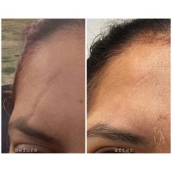 Sugar'n Sculpt Westlake - Microneedling Scar Treatment