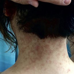 The reaction on the back of my neck resulting from Jeni Hester's disastrous hair job!