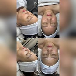 Glow Lift facial