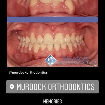 Murdock Orthodontics - Screenshot of before and after pics to update your dentist - Orthodontists Near Me - Cincinnati, Ohio