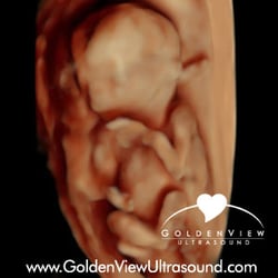 Goldenview Ultrasound 3d 4d HD Chicago - 3d ultrasound with hd live at 15 weeks