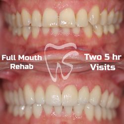Stanton Smiles - Full mouth rehab that normally takes many visits over months done in a little over one day!!!!