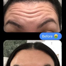 My results one week after Botox. Linh is the best My results one week after Botox. Linh is the best