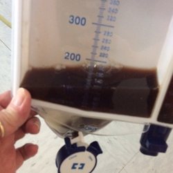 Garden Valley Manor and Rehab - My father was rushed to the hospital with a severe UTI and dehydration. This is a picture of his urine.