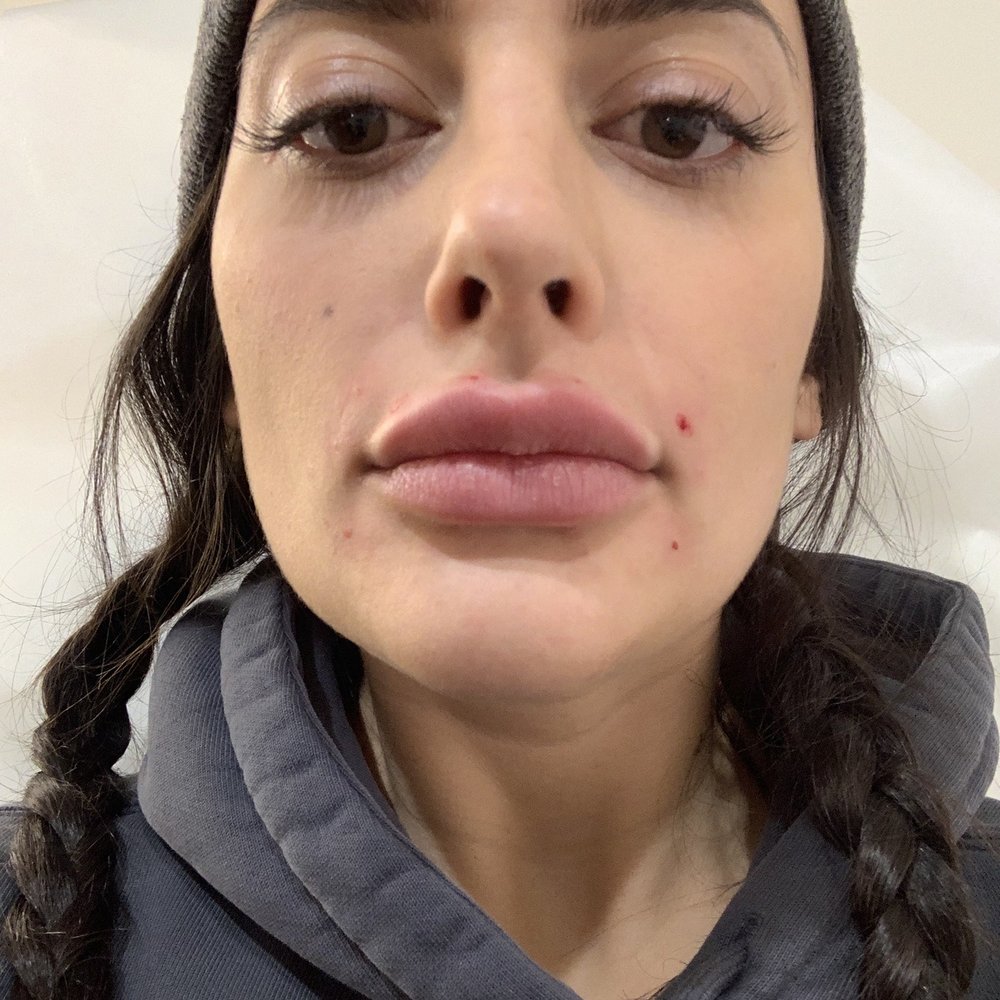 Manhattan Medspa - Still in their office right after Juverderm Ultra XC (1 Syringe) in lips and marionette lines - Medical Spas Near Me - New York, New York Manhattan Medspa - Still in their office right after Juverderm Ultra XC (1 Syringe) in lips and marionette lines - Medical Spas Near Me - New York, New York