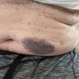 Bruising on the stomach. Bruising on the stomach.