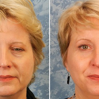 Roberts Cosmetic Surgery - Brow Lift - Skin Care Near Me - Plano, Texas