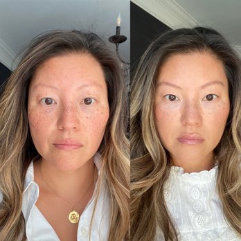 Ritual by Tracy Holzman NP-C - Before & After - Medical Spas Near Me - Washington, DC, District of Columbia Ritual by Tracy Holzman NP-C - Before & After - Medical Spas Near Me - Washington, DC, District of Columbia