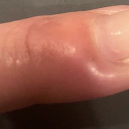 Contracted paronychia- major infection in my nail bed. Had to go to the urgent care, have it drained and needed an oral antibiotic. Contracted paronychia- major infection in my nail bed. Had to go to the urgent care, have it drained and needed an oral antibiotic.
