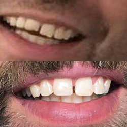 Valley Ridge Dental - Front tooth repair
