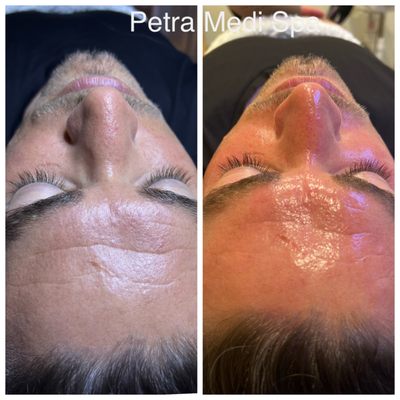 Get Glowing Skin with HydraFacial - REVITALIZE YOUR SKIN
Deeply cleanses and hydrates, offering a radiant complexion and rejuvenated skin with immediate results.
TARGETED TREATMENT FOR EVERY SKIN TYPE
Tailored to tackle specific skin issues, ensuring a personalized approach for optimal skin health and appearance.
EFFORTLESS RADIANCE
Achieve glowing, refreshed skin with no downtime, perfect for maintaining skin health as part of a regular beauty regimen. Get Glowing Skin with HydraFacial - REVITALIZE YOUR SKIN
Deeply cleanses and hydrates, offering a radiant complexion and rejuvenated skin with immediate results.
TARGETED TREATMENT FOR EVERY SKIN TYPE
Tailored to tackle specific skin issues, ensuring a personalized approach for optimal skin health and appearance.
EFFORTLESS RADIANCE
Achieve glowing, refreshed skin with no downtime, perfect for maintaining skin health as part of a regular beauty regimen.