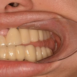 National Dental Bronx - As u can see, the front and bottom teeth don't even meet in the back, completely useless and that's not even the worst of it!
