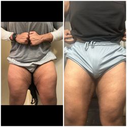 David Liland MD - Uneven contour one incision is cut back further than the other.