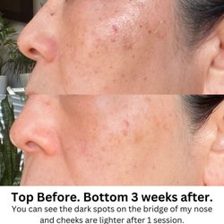 Luxury Medical Spa - You can see after only 1 session the hyperpigmentation is getting lighter! I'm so pleased!