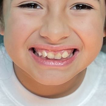 Freytag Orthodontics - Before Freytag - phase one braces - Orthodontists Near Me - Oro Valley, Arizona