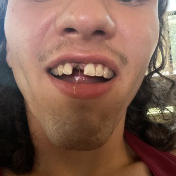 My Dentist - Tooth he fractured and had to get pulled - General Dentistry Near Me - Broken Arrow, Oklahoma My Dentist - Tooth he fractured and had to get pulled - General Dentistry Near Me - Broken Arrow, Oklahoma