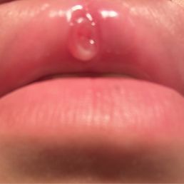 the result of getting an improper piercing. Thanks for this dope ass 60$ keloid:)