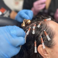 Face & Beyond Aesthetic Lounge - Hair Rejuvenation with PRF and smooth threads