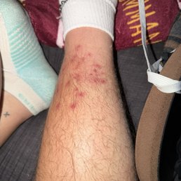 Bug bites