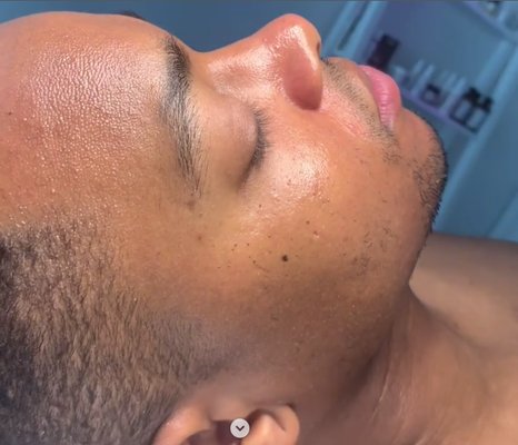 Facial Treatment Results - Beautiful Facial Results Facial Treatment Results - Beautiful Facial Results