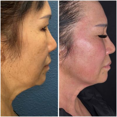 Trilift RF Microneedling - TriLift is our non-surgical facelift treatment that lifts, tightens, and tones the face using muscle stimulation, radiofrequency, and microneedling—all with no downtime. It’s like a workout, skin tightening, and collagen boost in one! Trilift RF Microneedling - TriLift is our non-surgical facelift treatment that lifts, tightens, and tones the face using muscle stimulation, radiofrequency, and microneedling—all with no downtime. It’s like a workout, skin tightening, and collagen boost in one!