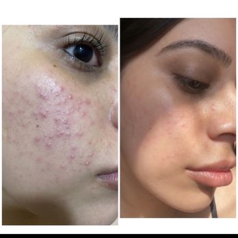 Suit Yourself Skin Care - 4 week progress after being consistent with my customized skin care regimen! - Skin Care Near Me - San Clemente, California