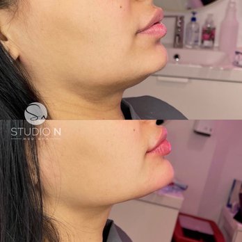 Studio N - Chin and lips - Medical Spas Near Me - Philadelphia, Pennsylvania Studio N - Chin and lips - Medical Spas Near Me - Philadelphia, Pennsylvania