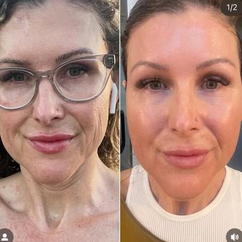 The Skin Center - Skin pen microneedling - Estheticians Near Me - Scottsdale, Arizona The Skin Center - Skin pen microneedling - Estheticians Near Me - Scottsdale, Arizona