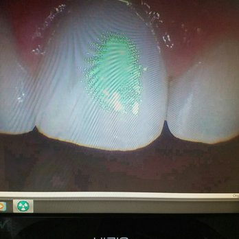 Sachin P Desai, DDS - Like if there were no chippings at all!! Thanks Dr.!! - Cosmetic Dentists Near Me - Glendora, California Sachin P Desai, DDS - Like if there were no chippings at all!! Thanks Dr.!! - Cosmetic Dentists Near Me - Glendora, California
