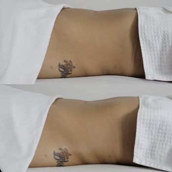 Bodyby_emilyg - Body Contouring Near Me - Torrance, California Bodyby_emilyg - Body Contouring Near Me - Torrance, California