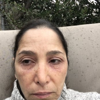 LaserAway - 1 week following treatment; Close in on the eyes and the lower face. - Medical Spas Near Me - Hermosa Beach, California LaserAway - 1 week following treatment; Close in on the eyes and the lower face. - Medical Spas Near Me - Hermosa Beach, California
