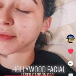 Glamour Laser Hair Removal - Carbon Laser/Hollywood FACIAL