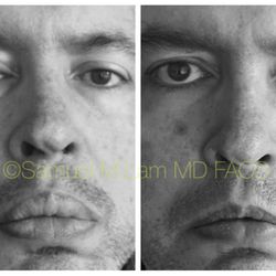 Lam Institute for Hair Restoration - This gentleman underwent upper and lower lip reduction to correct abnormal Fordyce spots and the resulting irregular shaped lips.