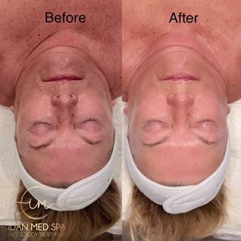 Idan Med Spa - Resurface renewal facial results - Medical Spas Near Me - Encino, California Idan Med Spa - Resurface renewal facial results - Medical Spas Near Me - Encino, California