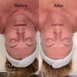 Idan Med Spa - Resurface renewal facial results