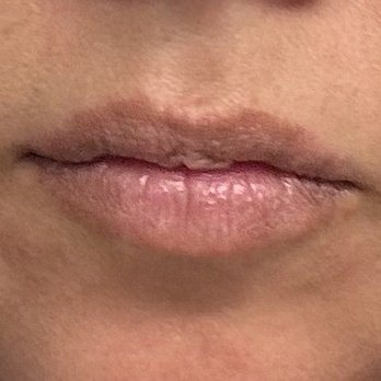 Beauty Cult - Before Lip Filler - Medical Spas Near Me - Redondo Beach, California Beauty Cult - Before Lip Filler - Medical Spas Near Me - Redondo Beach, California
