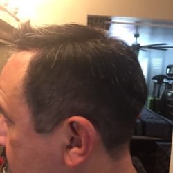 HRC II-West Covina - New customer, no previous hair on top. After hair replacement.
