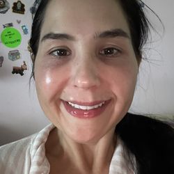 Skin NV Tampa Med Spa - 4 hours after first dissolving session!