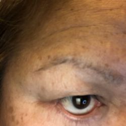 Lily Lee, MD - After second surgery, my eye waters in the corner all the time now